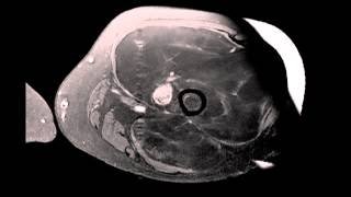 Well differentiated Liposarcoma Left Thigh [upl. by Baggs15]