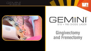 Gingivectomy and Frenectomy for Orthodontics  How to Use the Gemini™ Laser [upl. by Tamra]