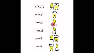 GV Black’s Dental Caries Classification [upl. by Thgiwed]