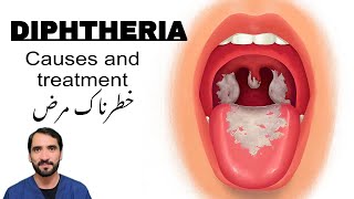 Diphtheria  Symptoms Causes and treatment [upl. by Oech693]