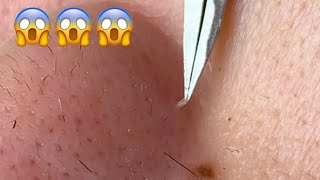 กดสิว blackheads filaments on nose remove with tweezers [upl. by Aime]