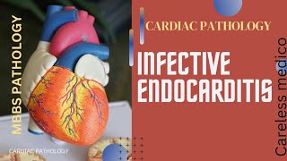 CARDIAC PATHOLOGY Infective Endocarditis lecture17pathology pathoma mbbs robbin cvs [upl. by Joby]