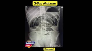 Diagnosis  X Ray Abdomen  Practical case  Radiology [upl. by Heiney226]