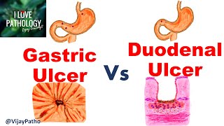 Peptic Ulcer Disease GASTRIC VS DUODENAL ULCERS [upl. by Artie]