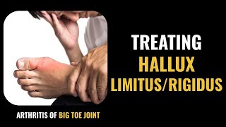 Hallux Limitus and Hallux Rigidus Treatment  Arthritis of the Big Toe Joint [upl. by Cooe]