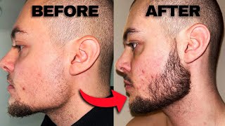 Minoxidil Beard Before And After  2 Months Progress [upl. by Tacy]