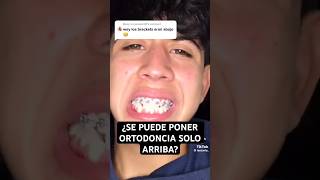 ¿Se puede poner ORTODONCIA solo en los DIENTES de ARRIBA  Brackets [upl. by Chiarra]