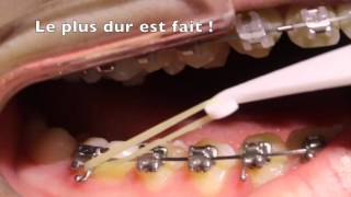 Mettre ses élastiques intermaxillaires en orthodontie [upl. by Bowman316]