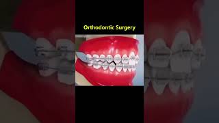 Ortho Treatment open bite العلاج التقويم للعظه المفتوحه 🎖️👌 [upl. by Ylro]