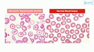 microcytic hypochromic anemia [upl. by Ennoved]