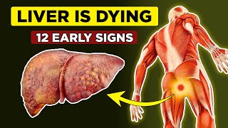 LIVER is DYING 12 Weird Signs of Liver Damage  Healthify [upl. by Dett]