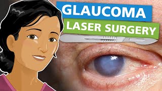 Glaucoma Laser Surgery [upl. by Bonnice]