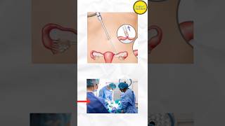 Vasectomy or Tubectomy difference [upl. by Gwennie]