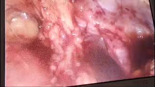 CYSTECTOMY🥼🥼DR MUSHAHID [upl. by Robbie938]