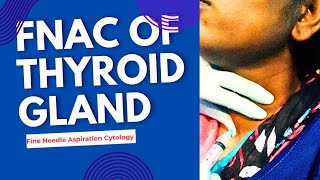 FNAC OF THYROID GLAND ।। [upl. by Jegger]