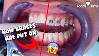 How Braces are put on  Dental Braces Tooth Time Family Dentistry New Braunfels Texas [upl. by Brittaney]