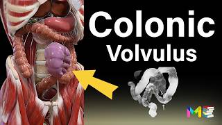 BOWEL OBSTRUCTION Colonic Volvulus [upl. by Quackenbush]