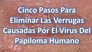 Remedios Caseros Para Eliminar Las Verrugas Causadas Por El Virus Del Papiloma Humano [upl. by Irrehs]