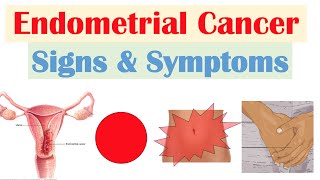 Endometrial Cancer Signs amp Symptoms amp Why They Occur [upl. by Raphael3]