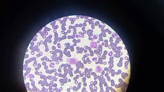 Leucémie  Promyélocytes Myélocytes Métamyélocytes Promonocytes et les blastes  سرطان الدم [upl. by Ardnalak480]