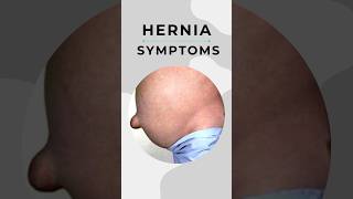 Hernia symptoms I Problems due to Hernia 7428617074 [upl. by Arahs]