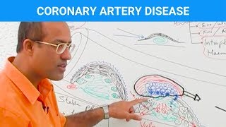 Coronary Artery Disease  Ischemic Heart Disease  Angina🫀 [upl. by Lacee730]