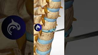 See how an Artificial Cervical Disc Replacement of the Spine works in 3D animation [upl. by Duff]