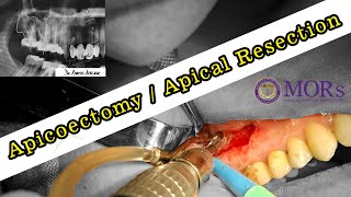 APICOECTOMY  Apical Resection  Root Canal Surgery [upl. by Violeta]