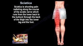 Sciatica what is causing it and how to treat it [upl. by Eelaras]