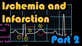 Ischemia Infarction and the Waveforms Q through U Part 2 How to Read an EKG Curriculum [upl. by Aciretnahs234]