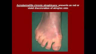 Lecture11 Dermatopathology Dermatoses with Perivascular inflammatory infiltrate [upl. by Armalda187]