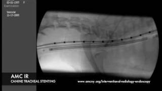 Interventional Radiology Tracheal Stent [upl. by Celie]