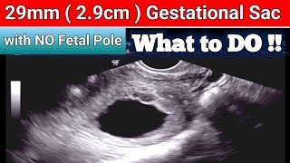 29mm Gestational Sac with NO Fetal Pole  is This Final Diagnosis of Missed Miscarriage [upl. by Suravaj]