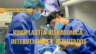 RINOPLASTIA ULTRASÓNICA INTERVENCIÓN Y RESULTADOS NATURALES [upl. by Afatsum]