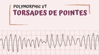 Torsades de Pointes [upl. by Sregor109]