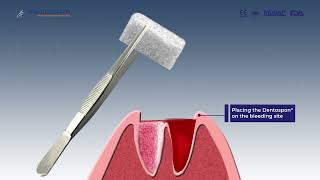 SURGISPON® DENTAL Absorbable Haemostatic Gelatine Sponge [upl. by Zanas]