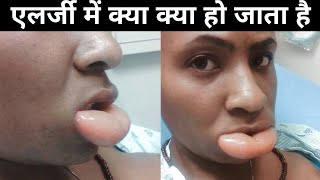 एलर्जी में शरीर के समय क्या होता हैं। allergy in hindi [upl. by Noemys]