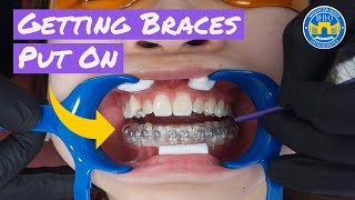 Process of Getting Braces [upl. by Etti]