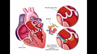 Treatment For Infective Endocarditis [upl. by Stefanie]