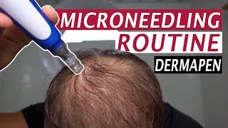 My Microneedling Routine and Derma Rolling for Hair Loss [upl. by Casimire140]