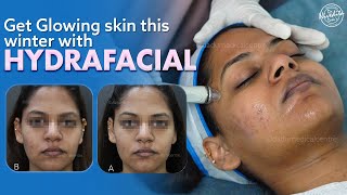 Hydrafacial treatment to cleanse extract and hydrate the skin [upl. by Keyte]