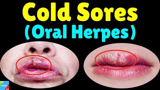 Cold Sores Oral HerpesHSV1  Fever Blisters – Symptoms Causes Treatment amp Prevention [upl. by Solotsopa]