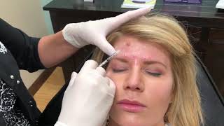 Allergan  Botox Injections [upl. by Assenad518]