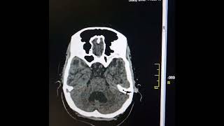 Leukoencephalopathy Mild obstructive hydrocephalus Mild cerebral atrophy [upl. by Harold332]