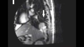 Dynamic Tumor Staging movement of tumor with respiration [upl. by Nnylrahc]