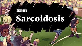 Understanding Sarcoidosis Causes Symptoms amp Treatment Part 1  Sketchy Medical  USMLE Step 2 CK [upl. by Eiramadnil907]