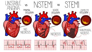 Acute Coronary Syndrome Heart Attack  Unstable Angina vs NSTEMI vs STEMI  With ECGs [upl. by Bobina]