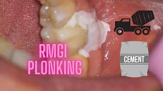 PLONKING conventional crown cementation RMGI cement [upl. by Susan126]