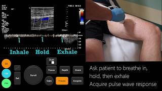 Ultrasound Tutorial DVT  Lower Limb Veins  Radiology Nation [upl. by Roer642]