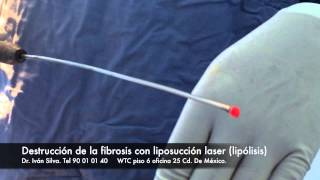 lipo laser fibrosis [upl. by Seniag15]